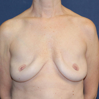45-54 year old woman treated with Breast Implant Revision before 3739064