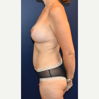 45-54 year old woman treated with Breast Lift with Implants after 3294028