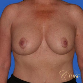 51 year old woman had an anchor breast lift with implants after 3502170