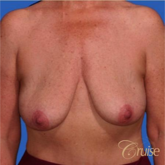 51 year old woman had an anchor breast lift with implants before 3502170