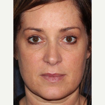 45-54 year old man treated with Voluma before 2063225