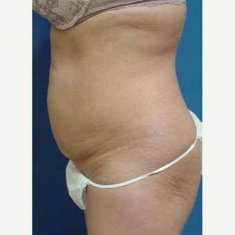 Tummy Tuck and Lipo before 3246465