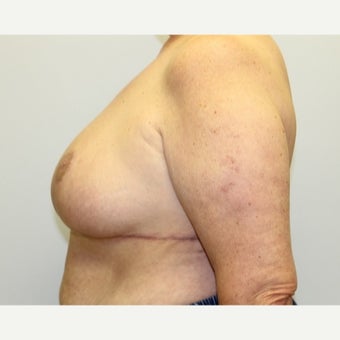 59 year old woman treated with Breast Reduction 1674838