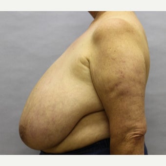 59 year old woman treated with Breast Reduction 1674838