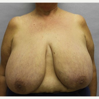 59 year old woman treated with Breast Reduction before 1674838