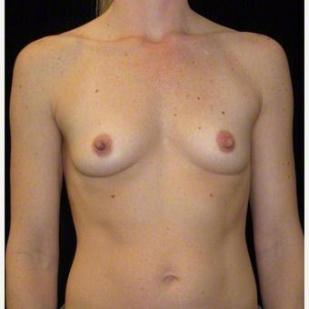 35 year old woman treated with Breast Augmentation before 3103640