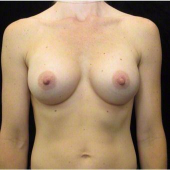 35 year old woman treated with Breast Augmentation after 3103640