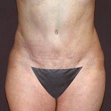 43 Year Old Female with a Revised Tummy Tuck after 952415