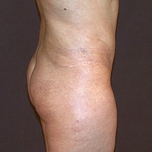 43 Year Old Female with a Revised Tummy Tuck 952415