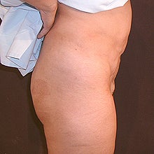 43 Year Old Female with a Revised Tummy Tuck 952415