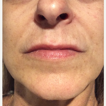 45-54 year old woman treated with Restylane Silk after 3459274