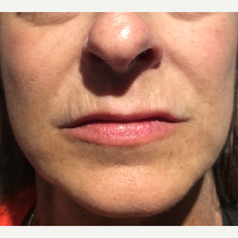 45-54 year old woman treated with Restylane Silk before 3459274