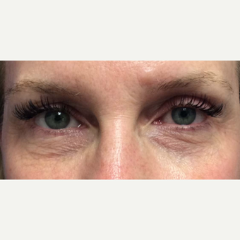 Laser Resurfacing of the Lower Eyelids for this 48 Year Old Woman before 3305569