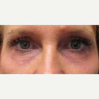 Laser Resurfacing of the Lower Eyelids for this 48 Year Old Woman after 3305569