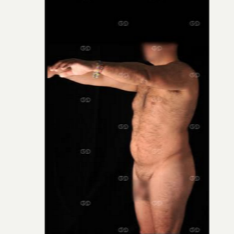 35-44 year old man treated with Liposculpture before 2595961