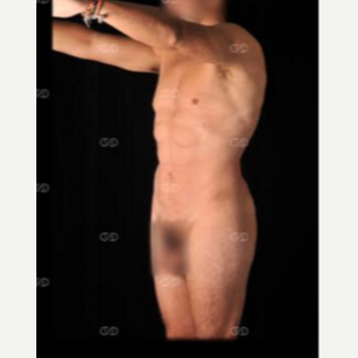 35-44 year old man treated with Liposculpture after 2595961