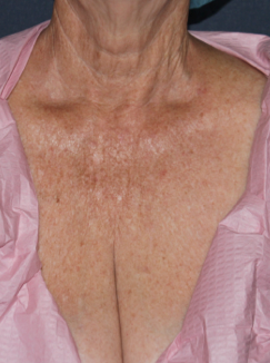 Fraxel Repair on Chest before 1064576