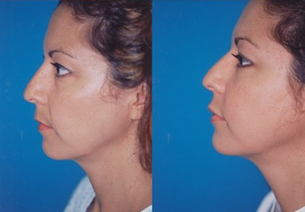 37-year-old woman treated with Facial Fat Transfer. after 574290