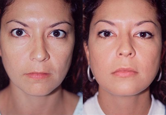 37-year-old woman treated with Facial Fat Transfer. before 574290