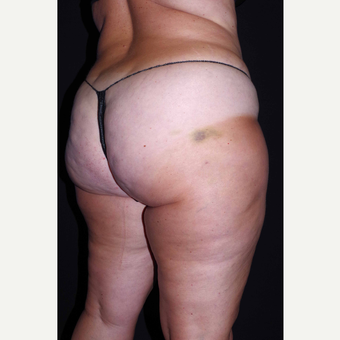 45-54 year old woman treated with Cellulaze after 3280743