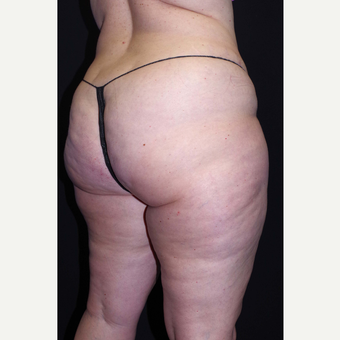 45-54 year old woman treated with Cellulaze before 3280743