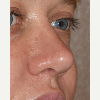 35-44 year old woman treated with Revision Rhinoplasty after 3438422