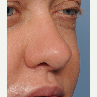 35-44 year old woman treated with Revision Rhinoplasty before 3438422