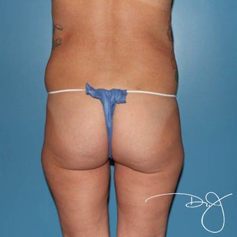 25-34 year old woman treated with Butt Augmentation before 1770183