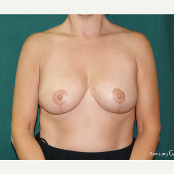 35-44 year old woman treated with Breast Lift/Reduction after 3658187