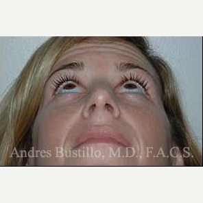 35 year old woman treated with Rhinoplasty after 3462377