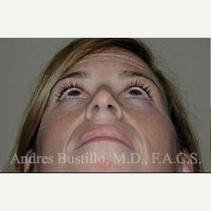 35 year old woman treated with Rhinoplasty before 3462377