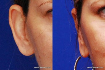 Ear Surgery before 1445748