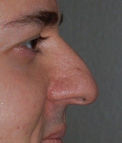 Rhinoplasty - Hump Reduction before 182599