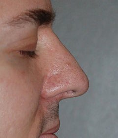 Rhinoplasty - Hump Reduction after 182599