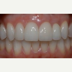 25-34 year old woman treated with Dental Implants after 2585808