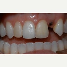 25-34 year old woman treated with Dental Implants before 2585808