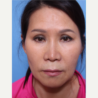 55-64 year old woman treated with Revision Rhinoplasty before 3507111