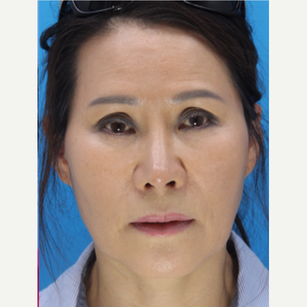 55-64 year old woman treated with Revision Rhinoplasty after 3507111