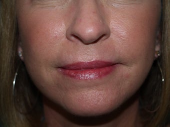 Dermabrasion for lines around the mouth after 1352459