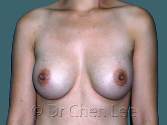 Ethnic Breast Augmentation after 930292