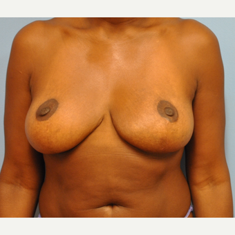 44 Year old woman treated with 500 g breast reduction. 36 H to 36 C after 3304117
