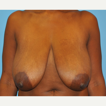 44 Year old woman treated with 500 g breast reduction. 36 H to 36 C before 3304117