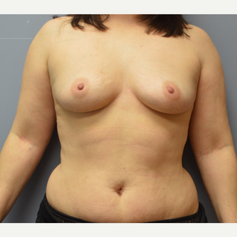 35-44 year old woman treated with Breast Reconstruction before 3142216