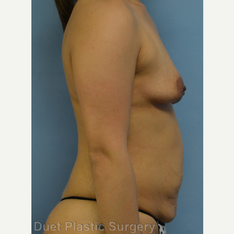 25-34 year old woman treated with Mommy Makeover before 3368224