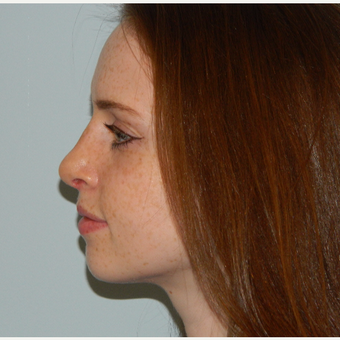 35-44 year old woman treated with Rhinoplasty after 3506472