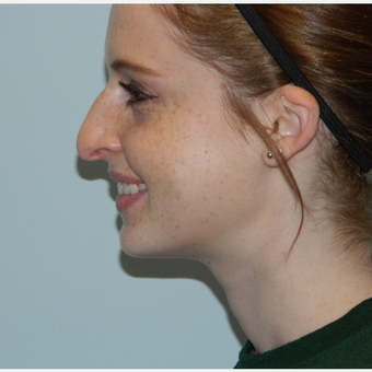 35-44 year old woman treated with Rhinoplasty before 3506472