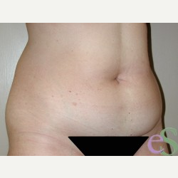 42 year old woman treated with Tummy Tuck before 3484939