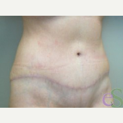 42 year old woman treated with Tummy Tuck after 3484939