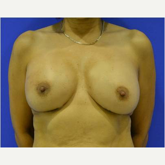 52 year old woman treated with Breast Reconstruction Revision after 3725423