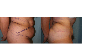 Abdominoplasty (tummy tuck) and Flank Liposuction after 401723